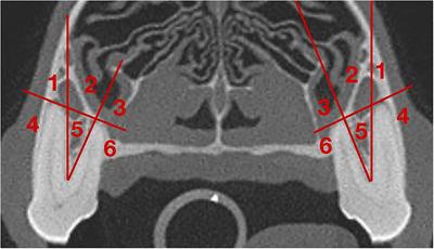 Analysis of the anatomic relationship of the infraorbital canal with the roots of the maxillary fourth premolar tooth in the three different skull types: Mesocephalic, brachycephalic, and dolichocephalic, using cone beam computed tomography